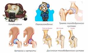 Симптомы и лечение бурсита тазобедренного сустава: полезная информация и советы