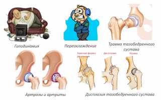 Симптомы и лечение бурсита тазобедренного сустава: полезная информация и советы