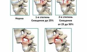 Почему возникает ретролистез и как его лечить? Полное руководство