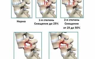 Почему возникает ретролистез и как его лечить? Полное руководство