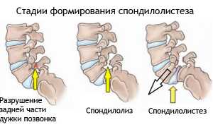 Почему развивается спондилолиз L5 позвонка и как его лечить: причины и методы