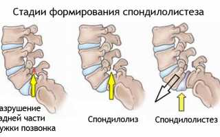 Почему развивается спондилолиз L5 позвонка и как его лечить: причины и методы