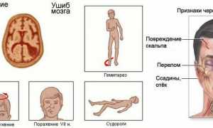 Как долго нужно прикладывать лед при ушибе? Узнайте полезные советы