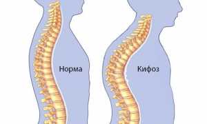 Выполнение массажа спины при кифозе позвоночника для улучшения здоровья