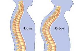 Выполнение массажа спины при кифозе позвоночника для улучшения здоровья