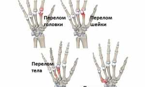 Признаки и методы лечения перелома пальца на руке: полезные советы