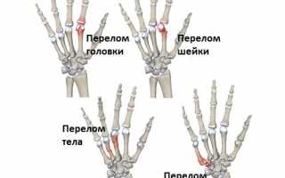 Признаки и методы лечения перелома пальца на руке: полезные советы