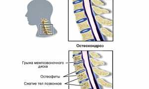 Выполнение зарядки при шейном остеохондрозе для улучшения здоровья