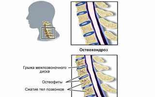 Выполнение зарядки при шейном остеохондрозе для улучшения здоровья