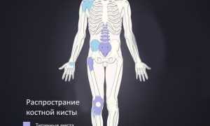 Симптомы развития костной кисты и способы ее лечения: важные аспекты