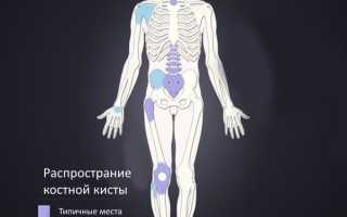 Симптомы развития костной кисты и способы ее лечения: важные аспекты