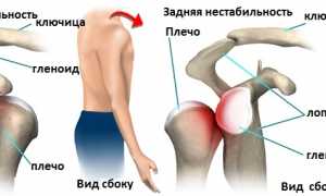 Как проводится операция Латарже на плечевом суставе? Полное руководство