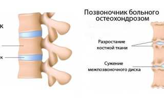 Растяжка позвоночника при остеохондрозе для улучшения здоровья