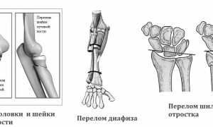 Виды перелома лучевой кости и методы лечения в современной медицине