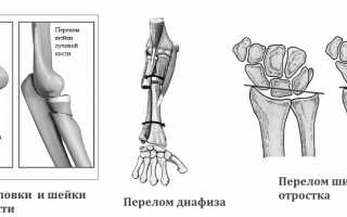 Виды перелома лучевой кости и методы лечения в современной медицине
