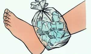 Какие компрессы нужно делать при растяжении связок для быстрого восстановления?