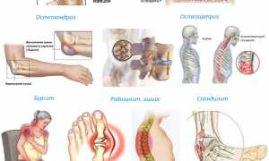 Какие заменители лекарства Флексен самые эффективные для лечения?