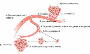 Почему возникает хондросаркома и как от нее избавиться? Полное руководство