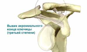 Операция при разрыве акромиально-ключичного сочленения: особенности и рекомендации