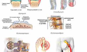 Гель Найз — эффективное средство для наружного применения при болях