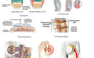 Гель Найз — эффективное средство для наружного применения при болях
