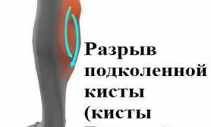 В чем заключается опасность разрыва кисты Бейкера для здоровья?