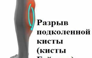 В чем заключается опасность разрыва кисты Бейкера для здоровья?