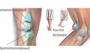 Симптомы и лечение бурсита коленного сустава: важные аспекты здоровья