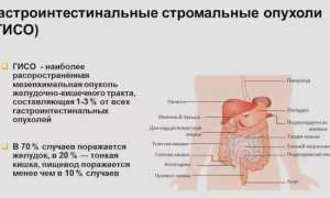 Гастроинтестинальная стромальная опухоль: причины и лечение