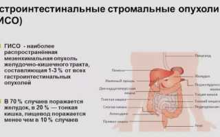 Гастроинтестинальная стромальная опухоль: причины и лечение
