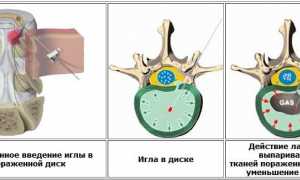 Эффективное удаление грыжи позвоночника лазером: современные методы и преимущества