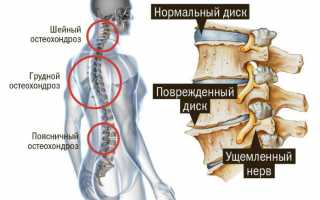 Можно ли при хондрозе спины делать массаж для облегчения симптомов?