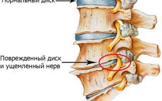 Польза обливания холодной водой при остеохондрозе для здоровья