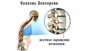 Современные препараты при болезни Бехтерева: эффективные решения для пациентов