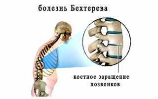 Современные препараты при болезни Бехтерева: эффективные решения для пациентов