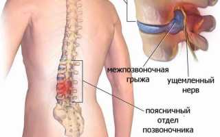 Техника проведения миелографии позвоночника и что она показывает для диагностики