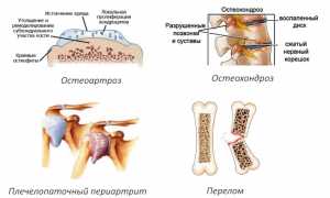 Механизм действия и способ приема Терафлекса Адванс для здоровья суставов