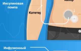 Что такое инсулиновая помпа и как ее выбрать на OZON для диабетиков