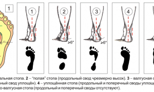 Что такое плоско-вальгусная стопа и как ее лечить? Полное руководство