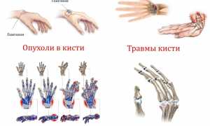 Проведение рентгена кисти руки и результаты обследования для диагностики