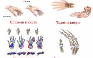 Проведение рентгена кисти руки и результаты обследования для диагностики