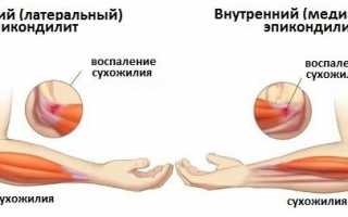 Как устранить боль в области локтя при сжатии кулака? Полезные советы и рекомендации