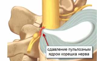 Как быстро вылечить радикулит в домашних условиях без лекарств