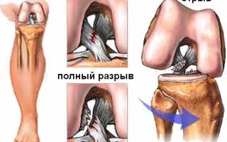 Проявление разрыва связок коленного сустава и его лечение: причины и рекомендации
