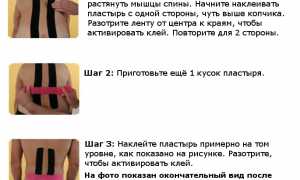 Эффективность кинезиотейпирования при грыже позвоночника: полезные советы и рекомендации