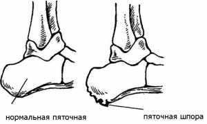 Почему может неметь стопа и как с этим бороться? Полезные советы
