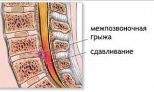 Причины повышения температуры при остеохондрозе у пациентов