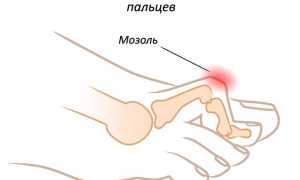 Причины возникновения и лечение косточки на ноге: советы и рекомендации