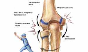 Как определить и лечить растяжение локтевого сустава у спортсменов
