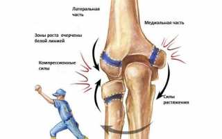 Как определить и лечить растяжение локтевого сустава у спортсменов